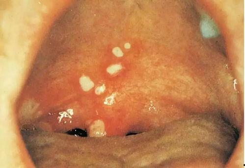 头部疱疹图片,症状、原因及预防措施解析 第3张 头部疱疹图片,症状、原因及预防措施解析 第3张